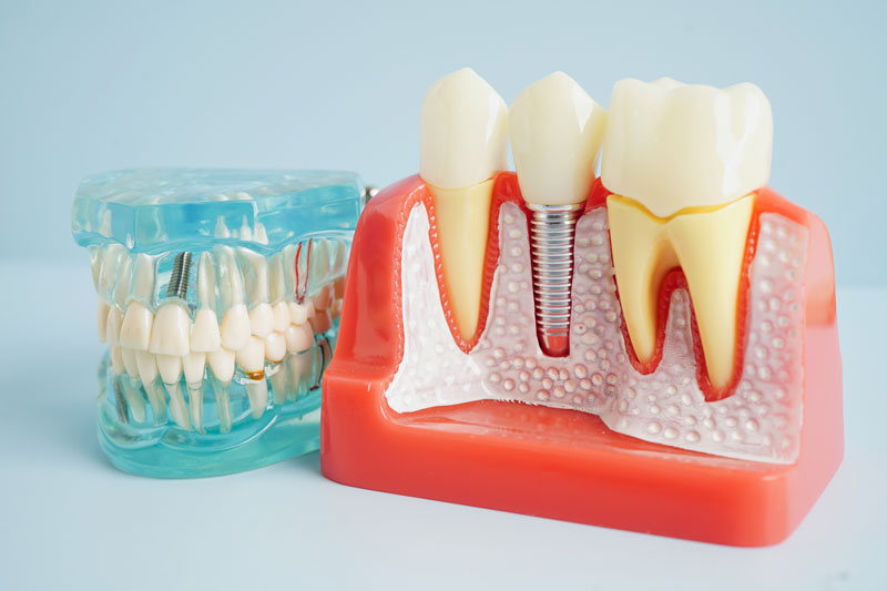 Unveiling the Mystery of Implant Dentistry in Hudson, NH