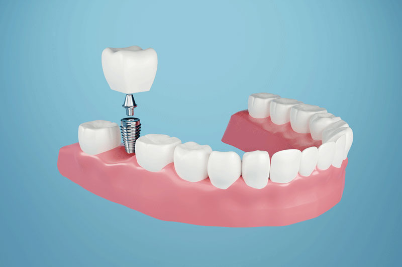 Jawbone Shrinkage After Tooth Loss: Can Complete Mouth Implants Stop It?