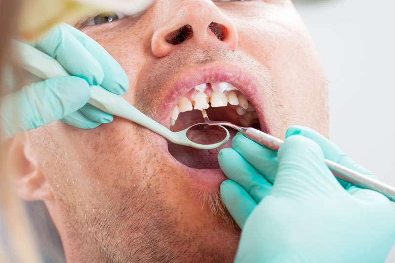 When Is a Tooth Extraction Really Necessary?