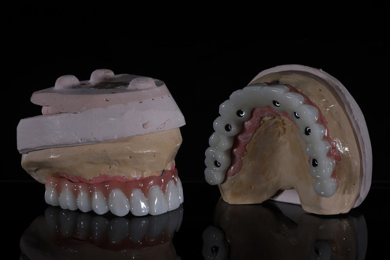 Unveiling the Benefits and Process of Dental Crowns in Burlington, MA
